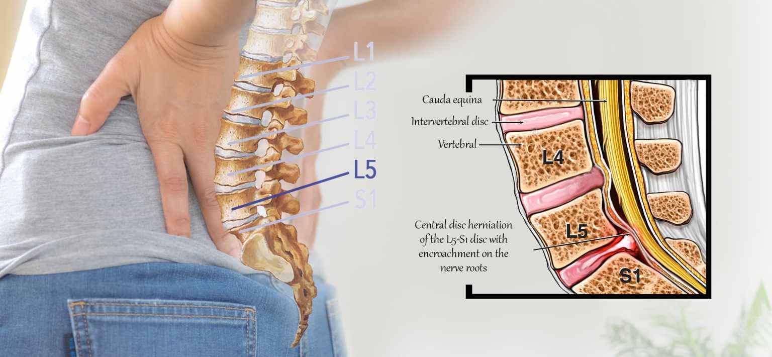 دیسک کمر چیست؟