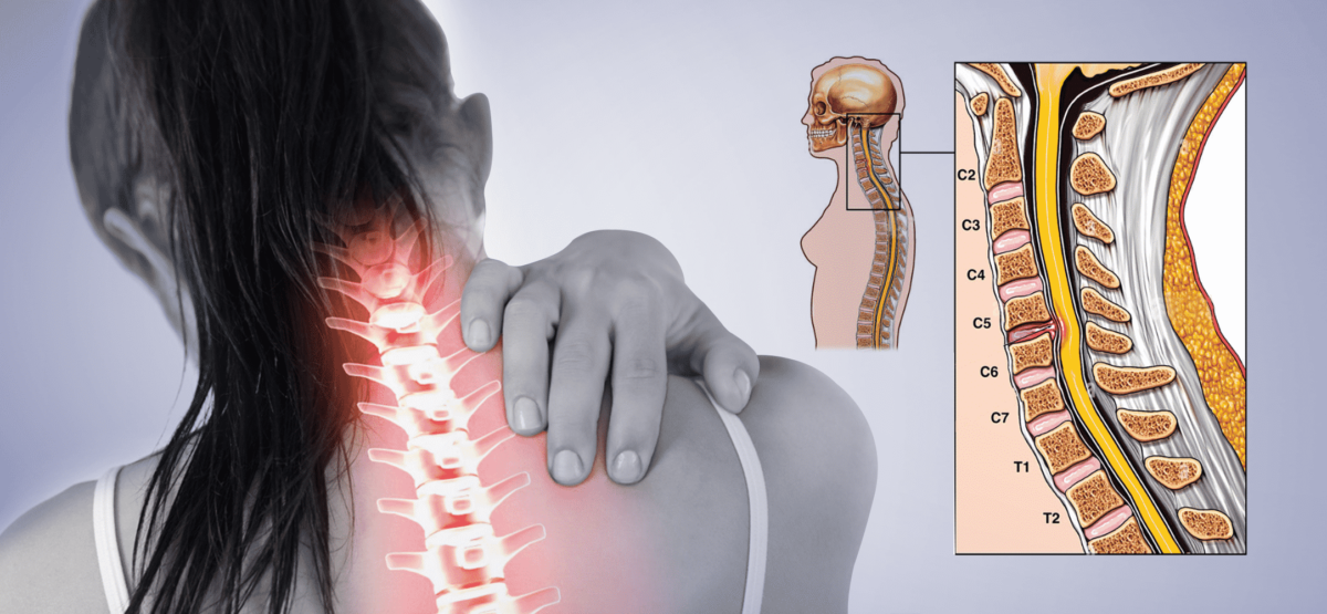 درمان پارگی دیسک گردن با کایروپراکتیک